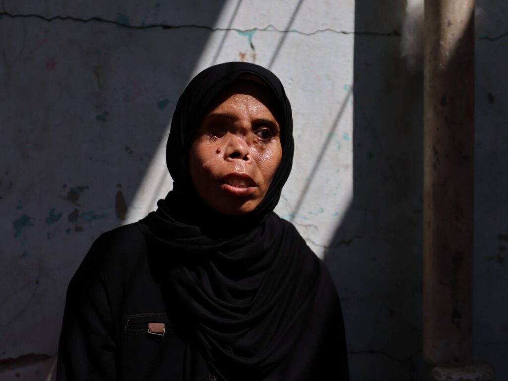 In Gaza, a long path to recovery for one woman who lost eye, and daughter